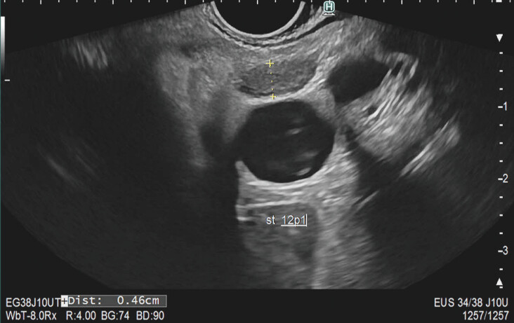 Interobserver variability in lymph node evaluation with endoscopic ultrasonography in cholangiocarcinoma.