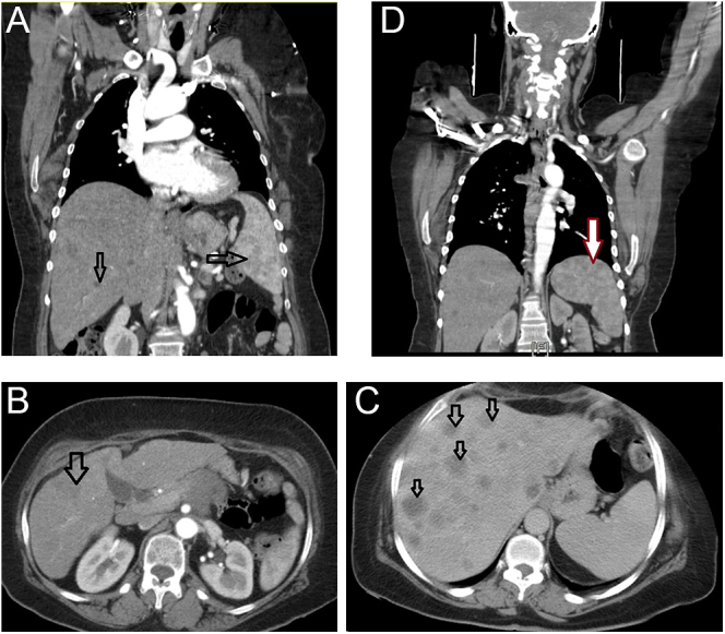 New-onset type 2 diabetes mellitus complicated by diabetic ketoacidosis: a sentinel presentation of advanced pancreatic adenocarcinoma.