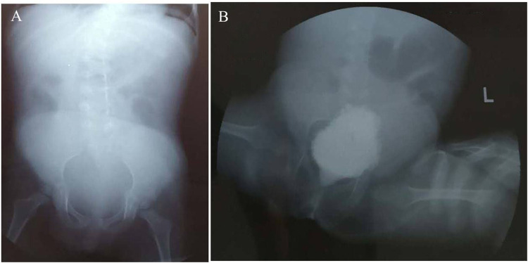 A Novel EBP c.452A>G Mutation Identified in a Girl with Conradi-Hünermann-Happle Syndrome Presenting with Hydronephrosis.