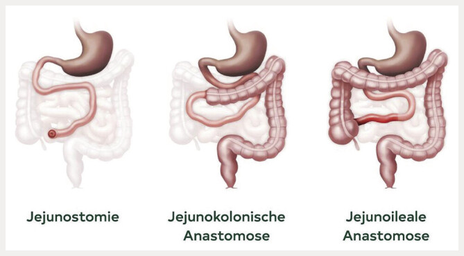 [Practical guideline for short bowel syndrome].