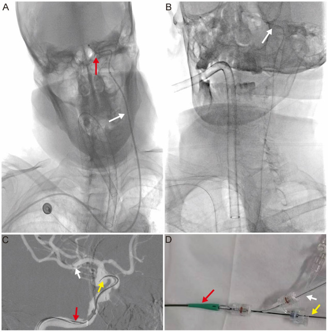 Feasibility and safety of 0.018-inch guidewire-supported distal access catheters in establishing transradial neurointerventional access.