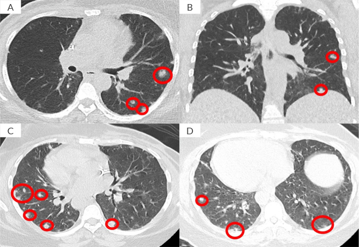 ANCA-Positive Pulmonary Granulomatosis in A HER2-Positive Breast Cancer Patient on ANTI-HER2 Therapy: Case Report and Literature Review.