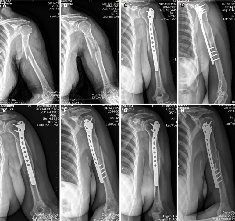 Parallax-free panoramic X-ray imaging combined with minimally invasive plate osteosynthesis for treating proximal humeral shaft fractures.