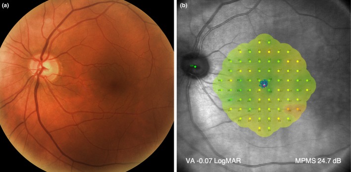 Charles Bonnet Syndrome associated with unilateral vision loss: A new diagnostic perspective.