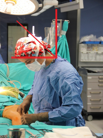 An Overlooked Hazard for Operating Room Nurses: Ergonomic Risks and Consequences Related to Working Position.