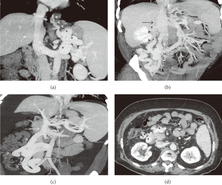 Non-variceal Extrahepatic Portosystemic Shunts: A Review of Pathogenesis, Diagnosis, and Treatment.