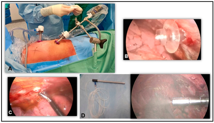 Safety and Efficacy of Pressurized Intra-Thoracic Aerosol Chemotherapy in Non-Small Cell Lung Cancer Pleural Carcinomatosis: Preliminary Results of a Pilot Study.