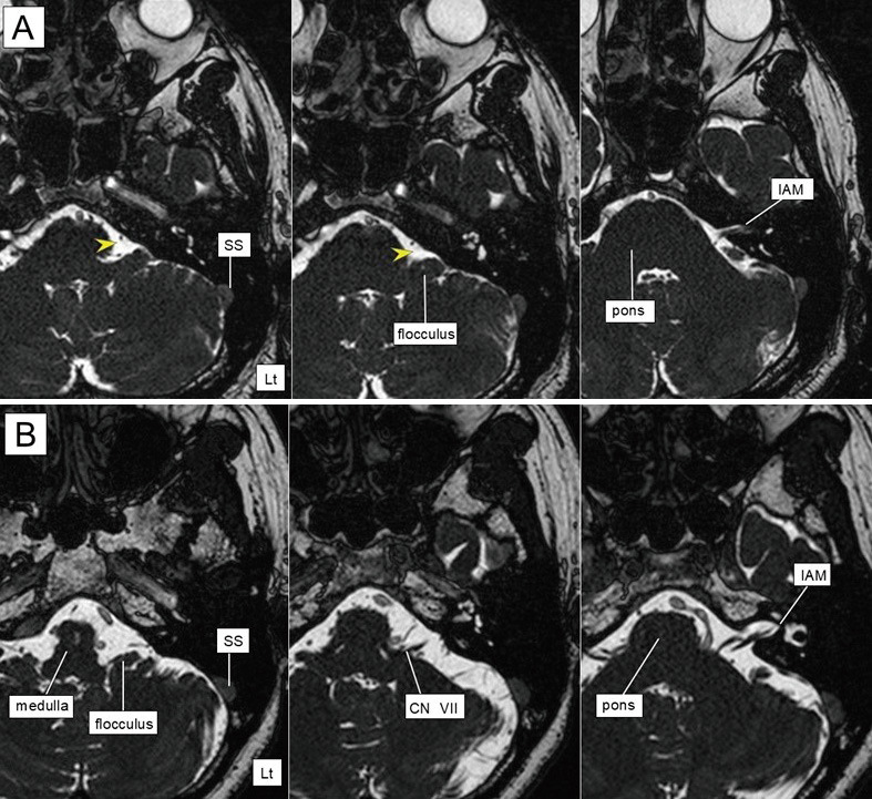 Comparison of Surgical Outcomes in Microscopic and Fully Endoscopic Microvascular Decompression for Hemifacial Spasm.
