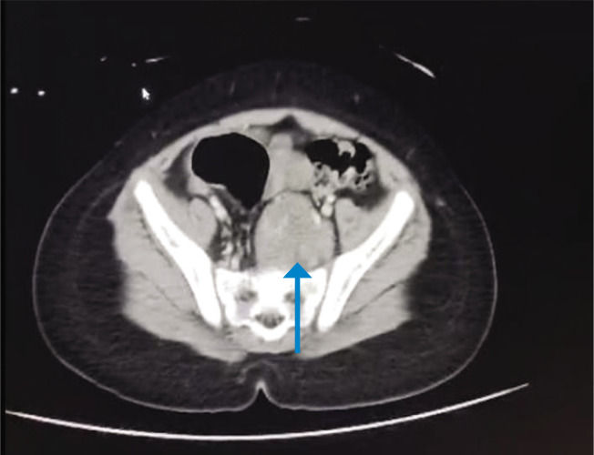 ROHHAD-NET Syndrome: A Case Series.