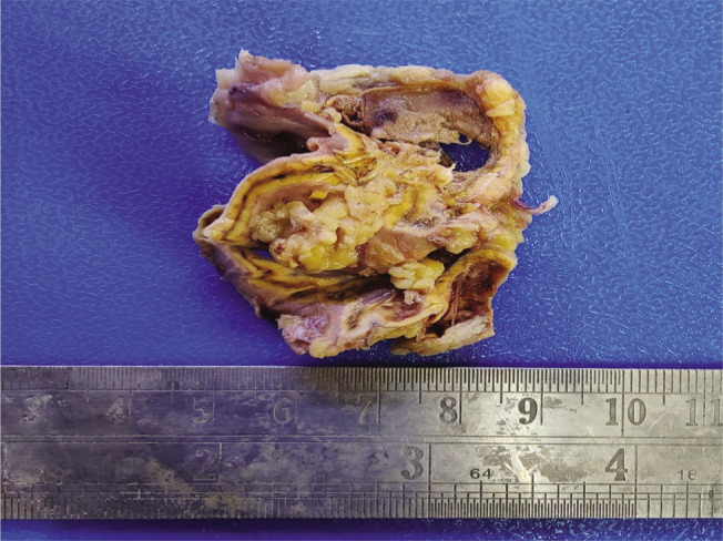 A Rare Case of Catecholamine-Secreting Adrenal Myelolipoma.