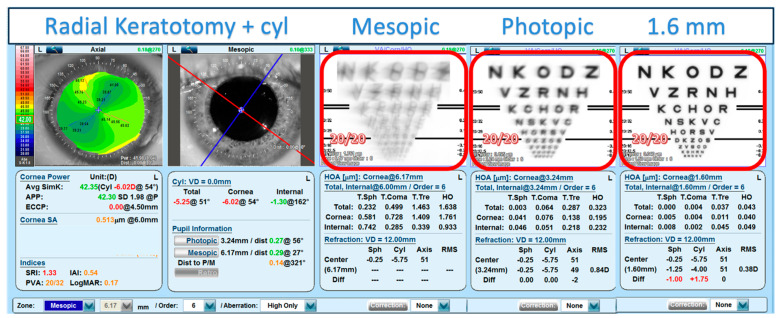 Predicted Visual Impact of a Small Aperture Intraocular Lens in Reducing Higher Order Aberrations in Post-Radial Keratotomy Patients.