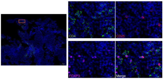 Tumor-infiltrating CD4<sup>+</sup> CD25<sup>+</sup> FOXP3<sup>+</sup> Treg is associated with plasma EBV DNA and disease progression in nasopharyngeal carcinoma.