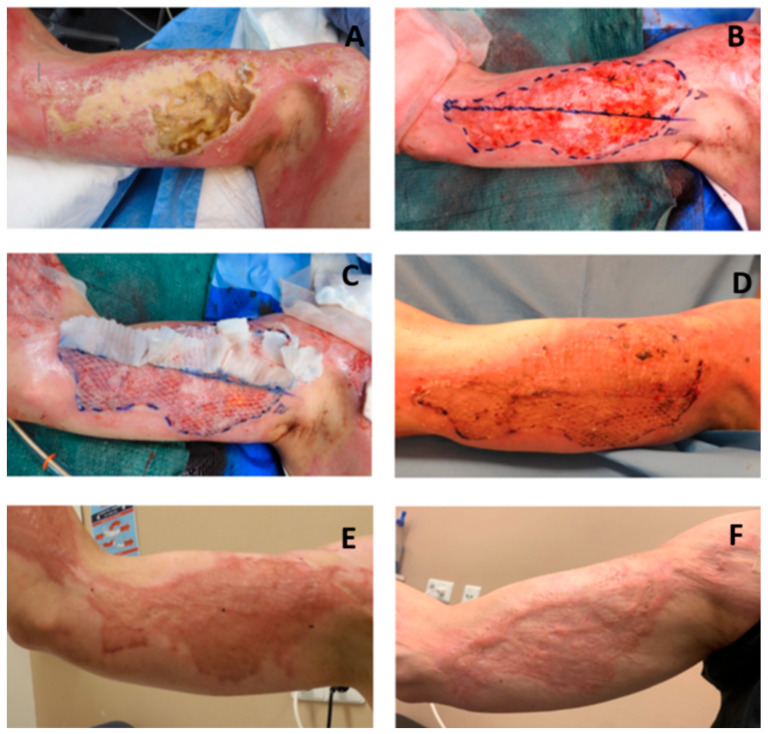 Wound and Short-Term Scar Outcomes of Meek Micrografting Versus Mesh Grafting: An Intra-Patient Randomized Controlled Trial.