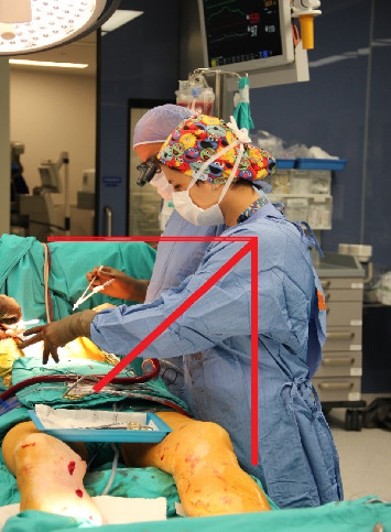 An Overlooked Hazard for Operating Room Nurses: Ergonomic Risks and Consequences Related to Working Position.