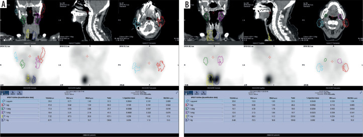 The relationship between radiomic features in CT images and the salivary gland SPECT/CT standardised uptake value using 3D analysis.