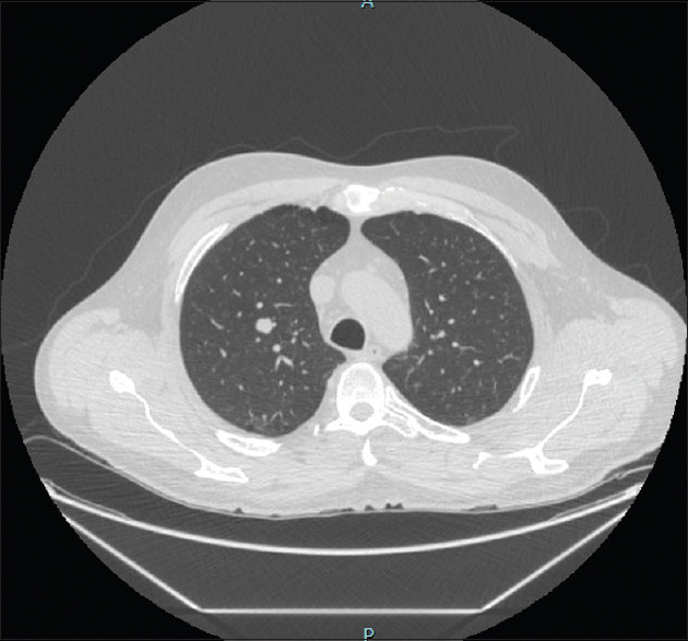 Endobronchial hamartoma; are the lines fading from the zebra? Case series and review of literature.