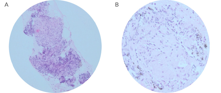ANCA-Positive Pulmonary Granulomatosis in A HER2-Positive Breast Cancer Patient on ANTI-HER2 Therapy: Case Report and Literature Review.