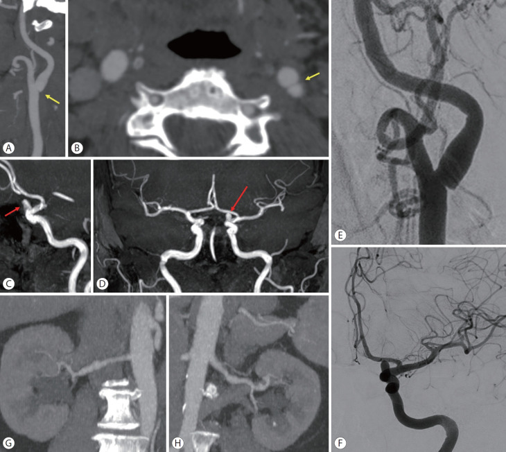 Carotid Web: An Update Focusing on Its Relationship With Fibromuscular Dysplasia and Therapeutic Strategy.