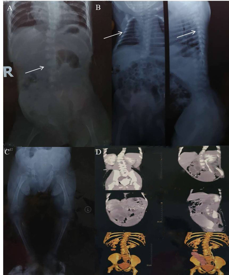 A Novel EBP c.452A>G Mutation Identified in a Girl with Conradi-Hünermann-Happle Syndrome Presenting with Hydronephrosis.