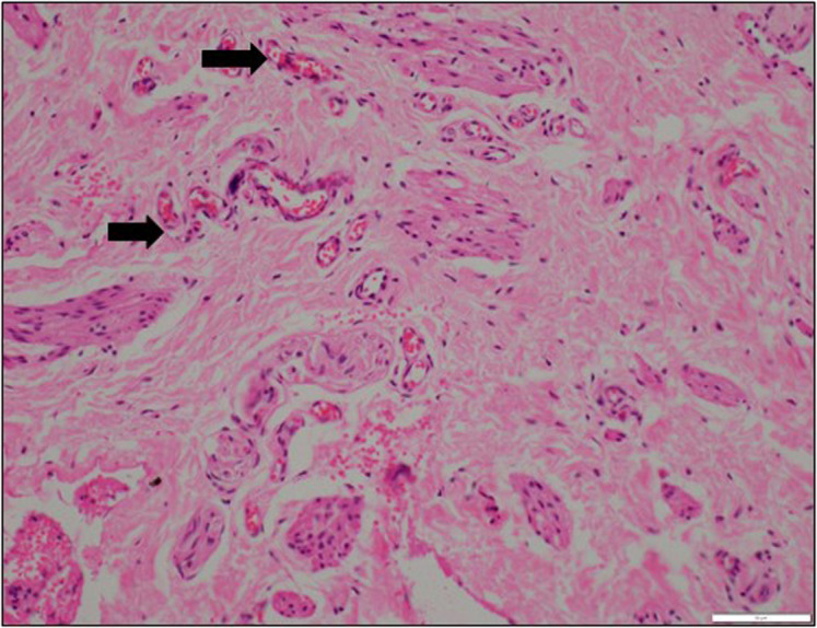 Comparison of Microvessel Density and Growth Factor Levels Between Inner and Outer Prepuce in Distal Hypospadias.