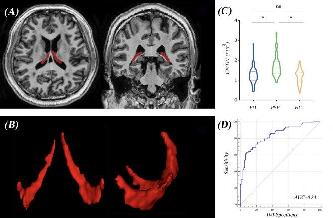 Choroid plexus enlargement correlates with subcortical tau deposition in progressive supranuclear palsy.