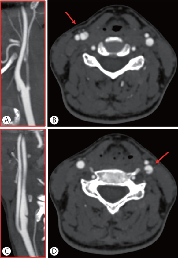 Carotid Web: An Update Focusing on Its Relationship With Fibromuscular Dysplasia and Therapeutic Strategy.