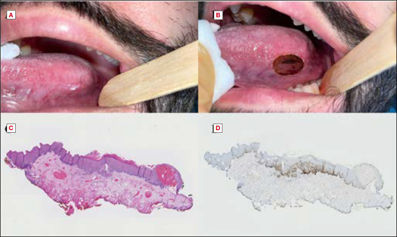 The impact of histology and molecular biology in refining the prognostic value of surgical margins in head and neck oncology - A narrative review.