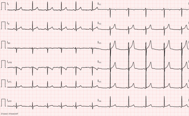 Severe Presentation of Cannabinoid Hyperemesis Syndrome With Mixed Acid-Base Disorder and Cardiac Complications: A Case Report.