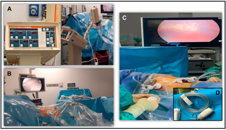 Safety and Efficacy of Pressurized Intra-Thoracic Aerosol Chemotherapy in Non-Small Cell Lung Cancer Pleural Carcinomatosis: Preliminary Results of a Pilot Study.