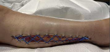 From Throat to Limb: A Novel Case of Compartment Syndrome Following Group A Streptococcal Pharyngitis.