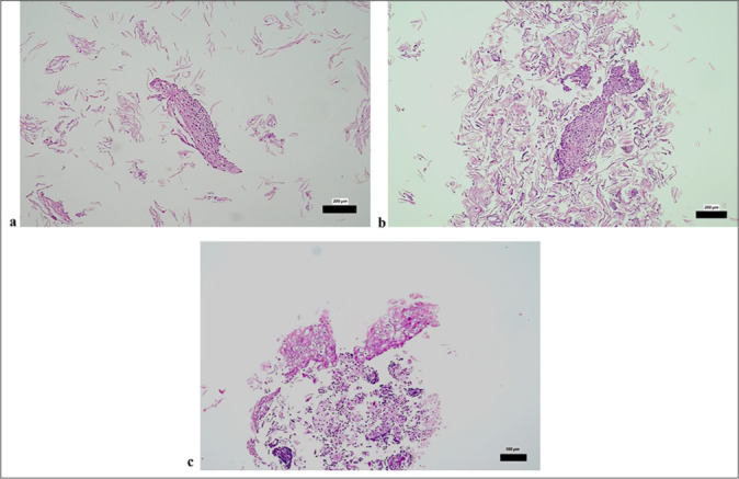Diagnostic utility of cell block preparations from liquid-based cytology in cervical lesions: A comparative retrospective analysis.