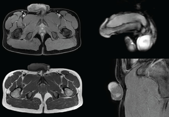 A Rare Case of Non-Hodgkin Lymphoma Presenting as a Penile Mass