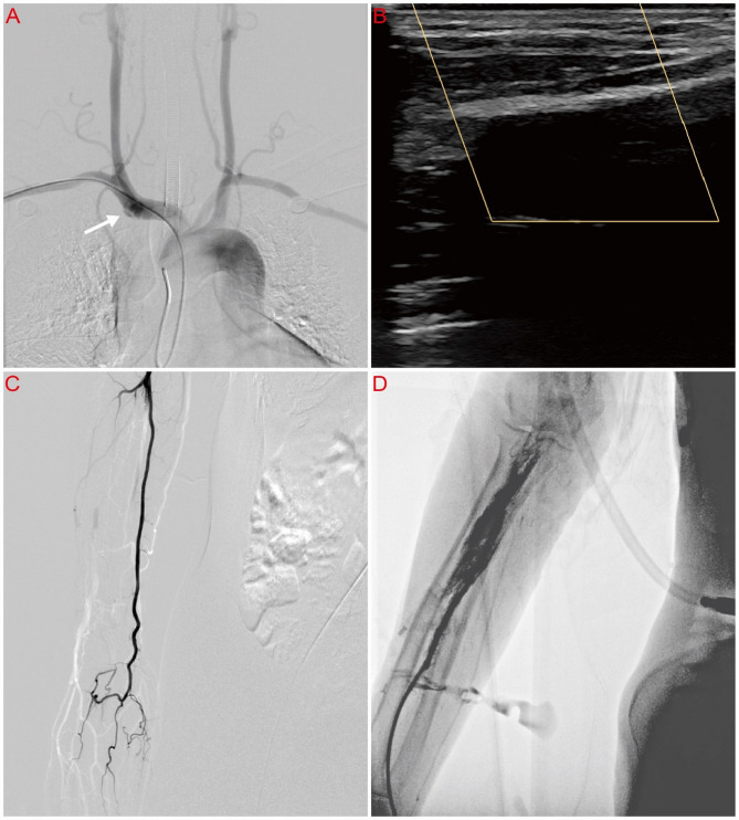 Feasibility and safety of 0.018-inch guidewire-supported distal access catheters in establishing transradial neurointerventional access.