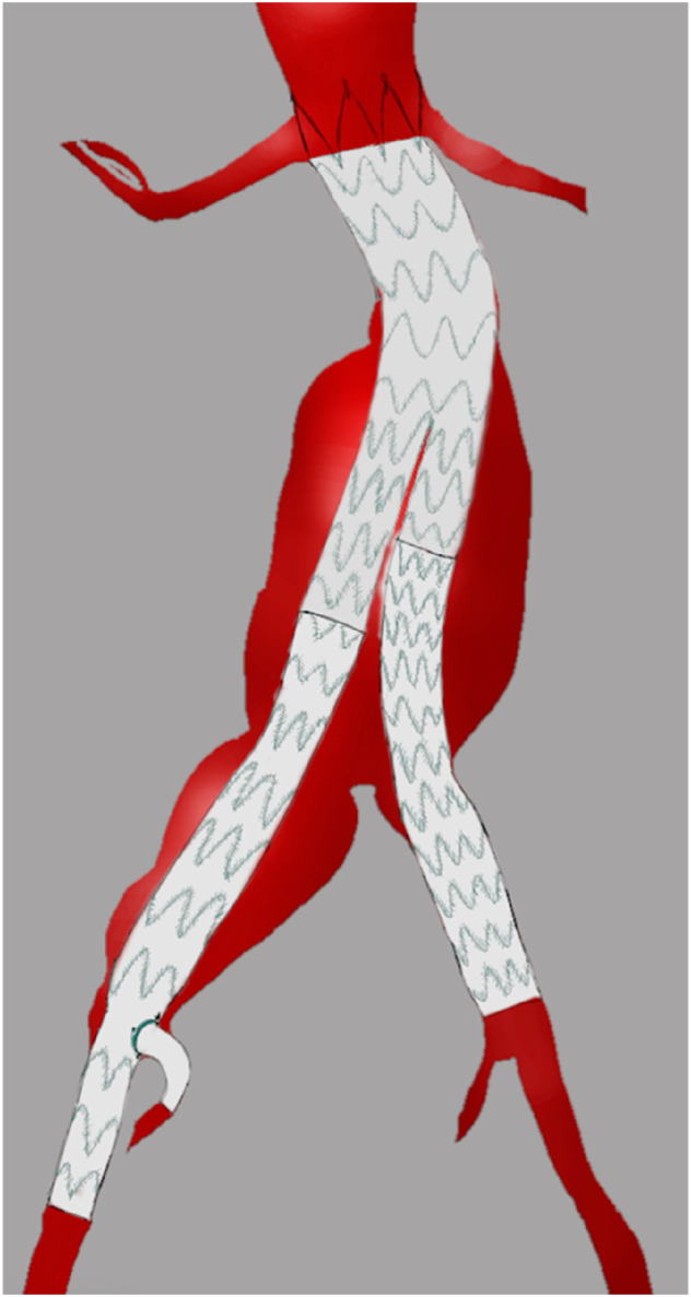 Preservation of Blood Flow to the Internal Iliac Artery Using a Custom-Made Single Fenestrated Endograft: A Case Report.