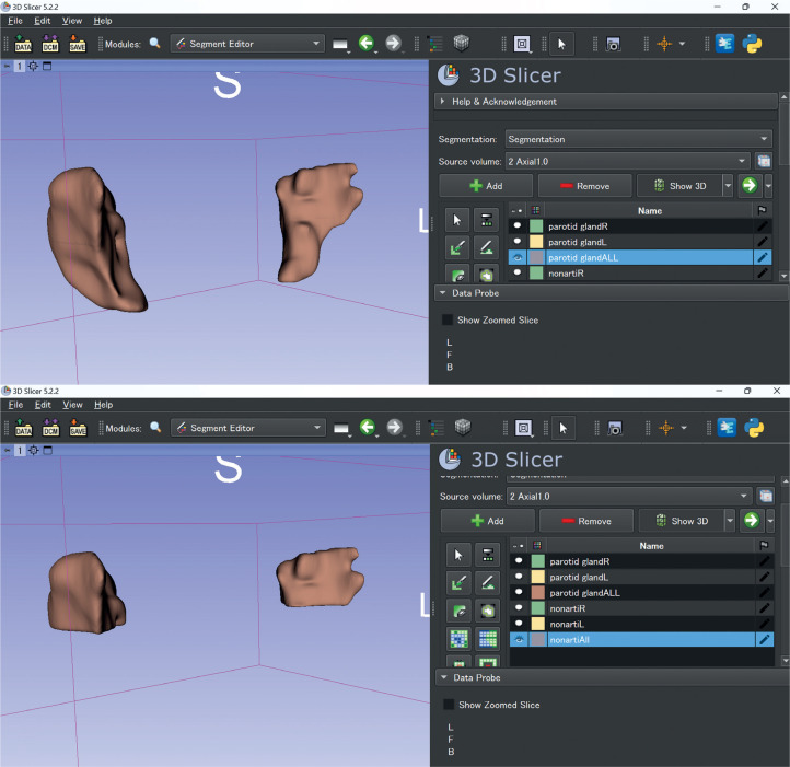 The relationship between radiomic features in CT images and the salivary gland SPECT/CT standardised uptake value using 3D analysis.