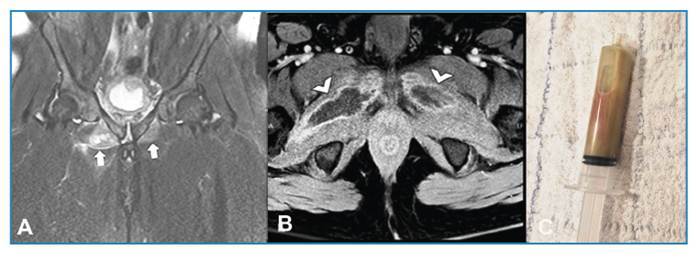 Pyomyositis in an immunocompetent man.
