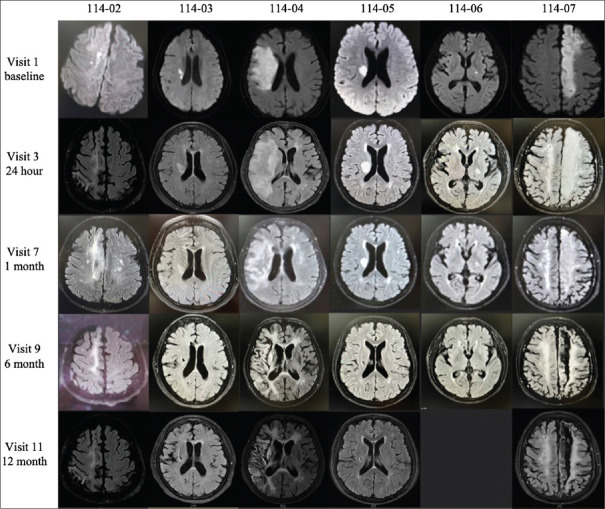 Allogeneic human umbilical cord blood for acute ischemic stroke: Phase I clinical trial.