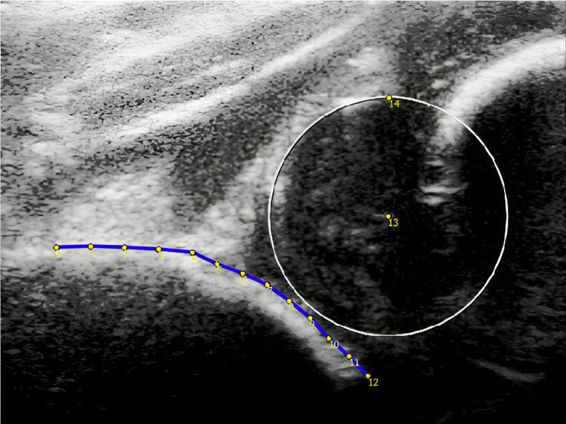 Ultrasound-based statistical shape modeling for prognosis in unstable hip dysplasia.