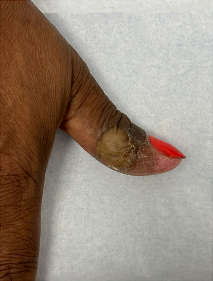 Management of Resistant Herpetic Whitlow: A Case of Recurrent Herpetic Whitlow Resistant to Standard Therapy.