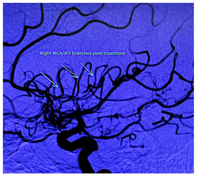 Reversible Cerebral Vasoconstriction Syndrome Induced by Sumatriptan: A Case Report and Review of Literature.