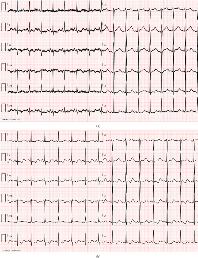 Severe Presentation of Cannabinoid Hyperemesis Syndrome With Mixed Acid-Base Disorder and Cardiac Complications: A Case Report.