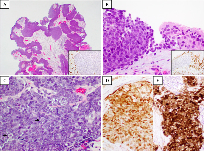 Clinicopathologic and Molecular Characterization of SMARCB1-Deificient Sinonasal Carcinomas -A Systematic Study from a Single Institution Cohort.