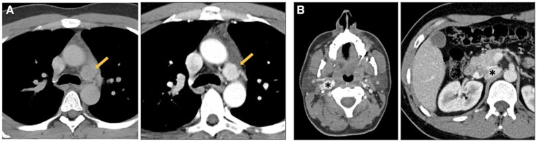 A diagnostic approach to mediastinal masses in clinical practice.