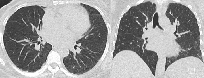 ANCA-Positive Pulmonary Granulomatosis in A HER2-Positive Breast Cancer Patient on ANTI-HER2 Therapy: Case Report and Literature Review.