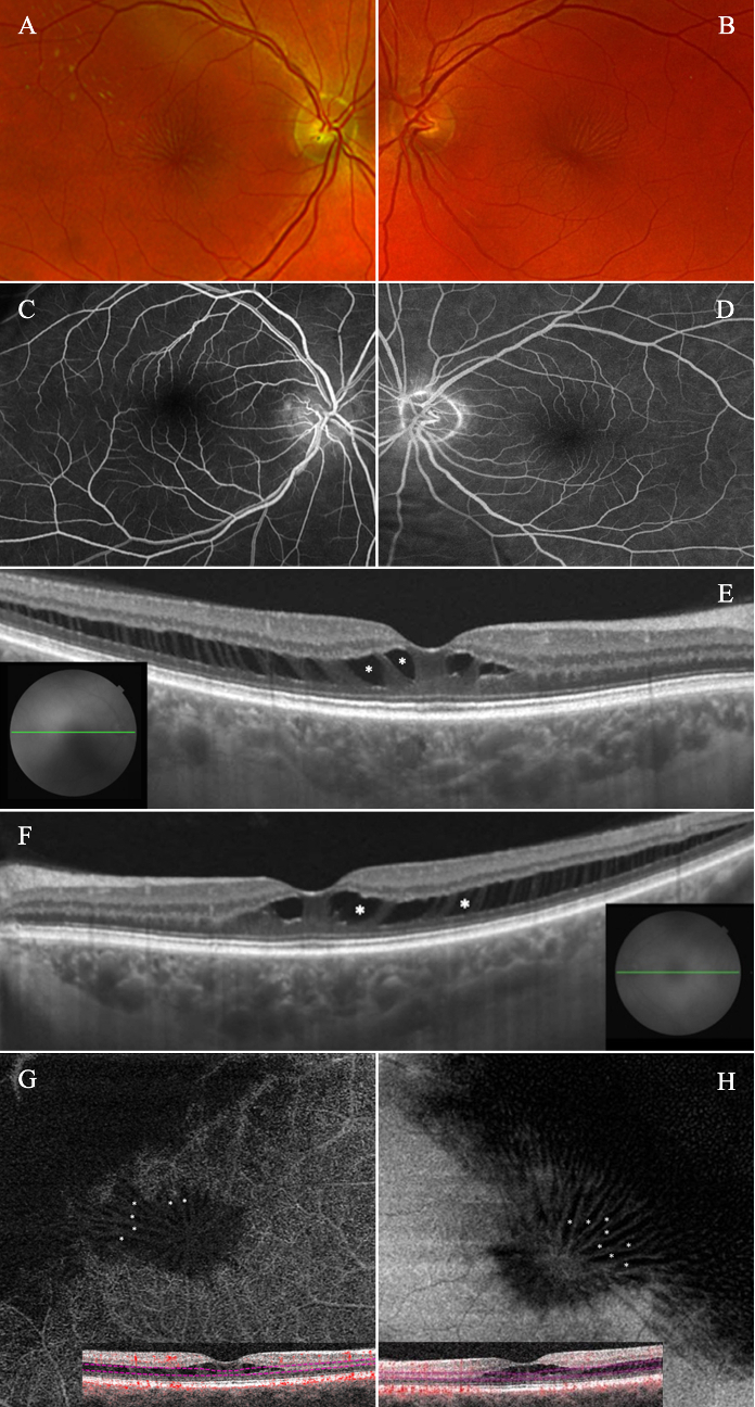 Star of the Diabetic Macular Show: Stellate Nonhereditary Idiopathic Foveomacular Retinoschisis (SNIFR).