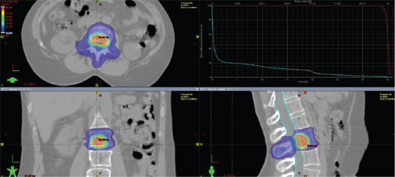 Simultaneous integrated boost intensity-modulated radiotherapy for treatment of bone metastases: analysis of a breast cancer cohort.