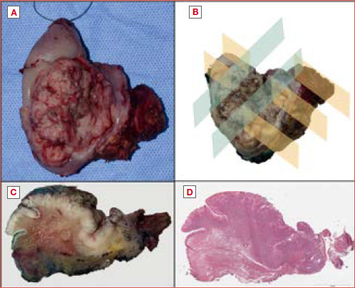 The impact of histology and molecular biology in refining the prognostic value of surgical margins in head and neck oncology - A narrative review.