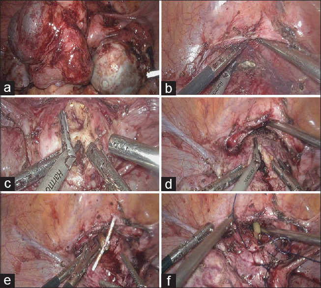 Restore the Continuity of Uterus-Cervix-Vagina for Cervical Restenosis after Cervicovaginal Reconstruction: A Case Report.