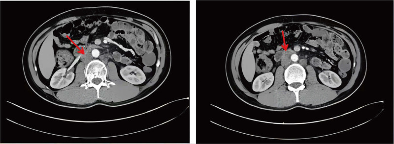 Robot-assisted laparoscopic retroperitoneal lymph node dissection in testicular cancer using a single-position supine approach: A case report and literature review.