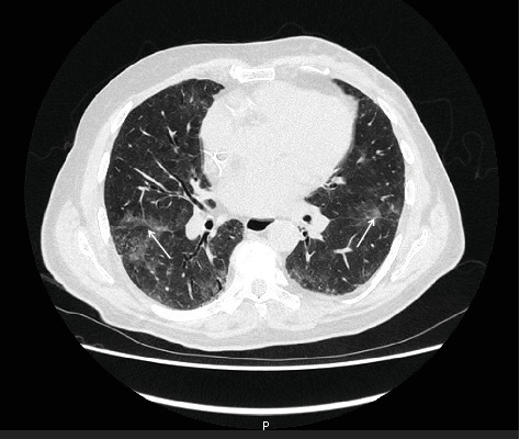 Case Report: Fatal <i>Pneumocystis jirovecii</i> Infection in an Elderly Man Receiving Adjuvant Paclitaxel and Trastuzumab Therapy for HER2-Positive Breast Cancer.